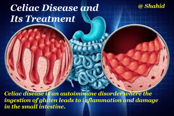 Image of Celiac Disease intestine image and disease symptoms