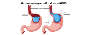 Showing the healthy and faulty picture of Complications of Showing the healthy and faulty picture of Gastroesophageal Reflux Disease (GERD)